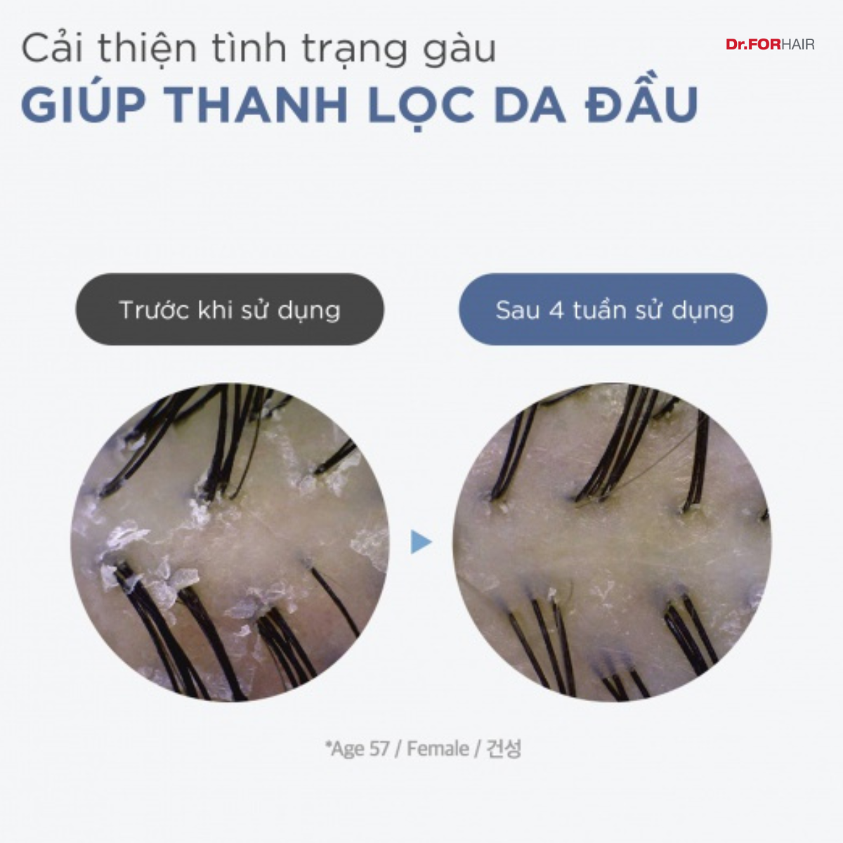 viêm da tiết bã