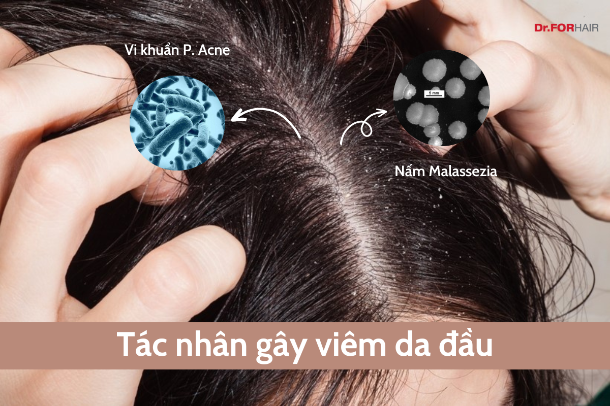 viêm da tiết bã 