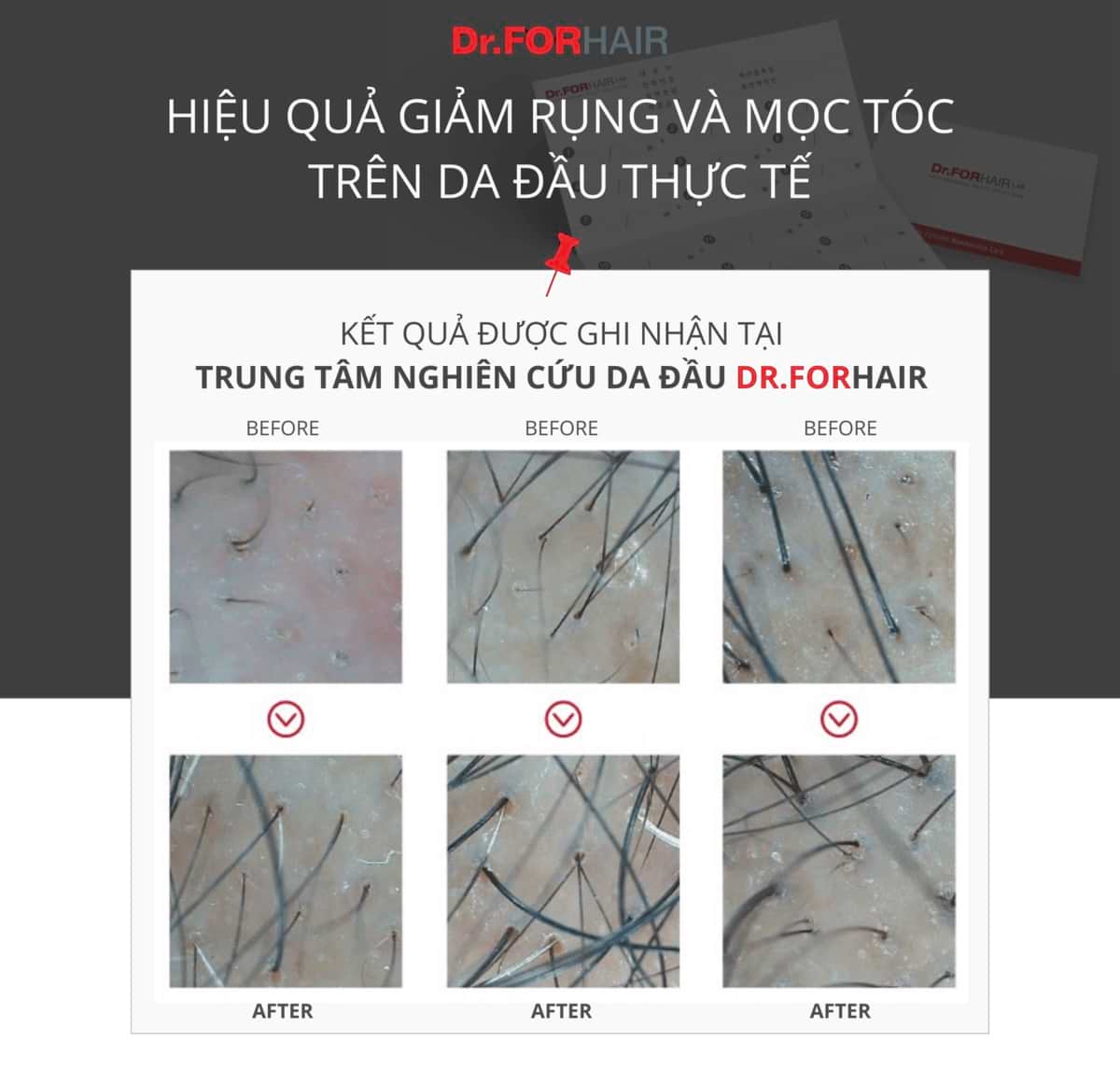 liệu trình giảm rụng tóc